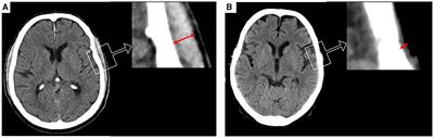 Frailty in cerebellar ischemic stroke—The significance of temporal muscle thickness